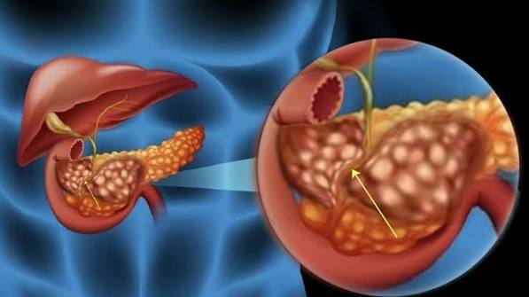 bile duct problems adults guide choledocholithiasis strictures PSC cholangiocarcinoma ERCP jaundice obstructive LFTs