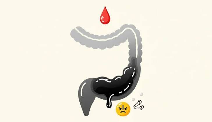 black-stool-what-it-may-mean-body — melena versus benign causes of black stool including iron and bismuth