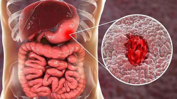 blood-in-stool-possible-causes-and-warning-signs-body — causes of rectal bleeding including hemorrhoids, colorectal cancer, and IBD