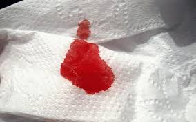 blood in stool possible causes and warning signs — hemorrhoids, colorectal cancer, diverticular bleeding, and IBD