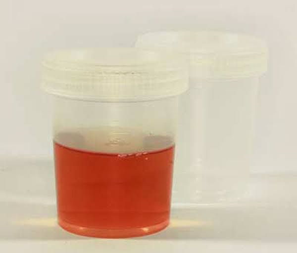 blood in urine hematuria bladder cancer kidney stone iga nephropathy