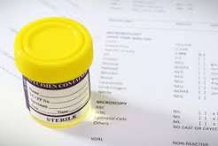 blood in urine hematuria causes from kidney stones bladder cancer UTI and glomerular disease