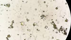 calcium oxalate stones — microscopic view and diagram showing crystal formation in the kidney collecting system and urinary tract