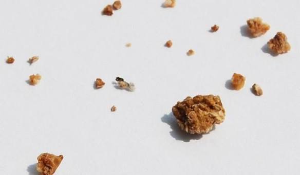 calcium oxalate stones — close-up image of retrieved kidney stone specimen with sharp crystalline edges characteristic of calcium oxalate monohydrate composition