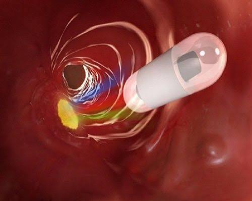 capsule-endoscopy-explained-body — capsule endoscopy sensor belt recorder data patient wearing device small bowel