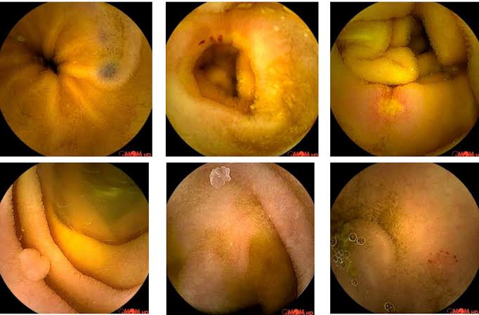 capsule endoscopy explained — PillCam wireless camera capsule small bowel imaging GI tract diagnosis