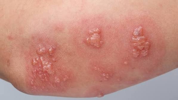 celiac disease symptoms diagnosis gluten villous atrophy anti-tTG IgA serology