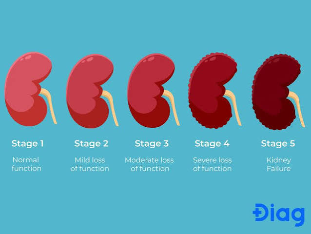 chronic kidney disease stages eGFR chart G1 to G5
