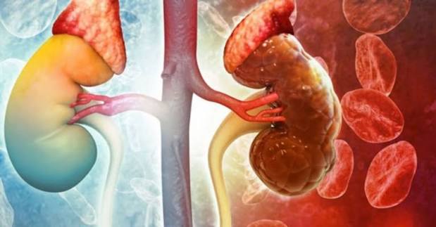 Comparison chart of chronic kidney disease vs acute kidney injury showing differences in timescale cause reversibility and treatment