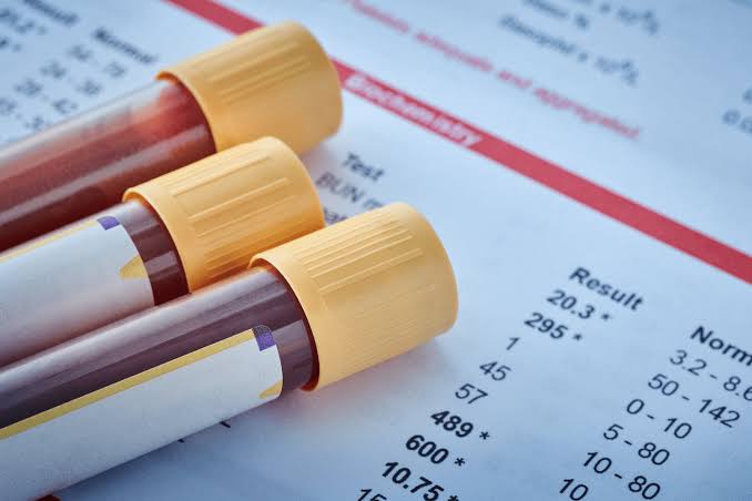 KDIGO CKD staging matrix showing eGFR and ACR categories for kidney function test interpretation