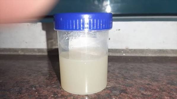 cloudy urine causes uti sterile pyuria proteinuria kidney