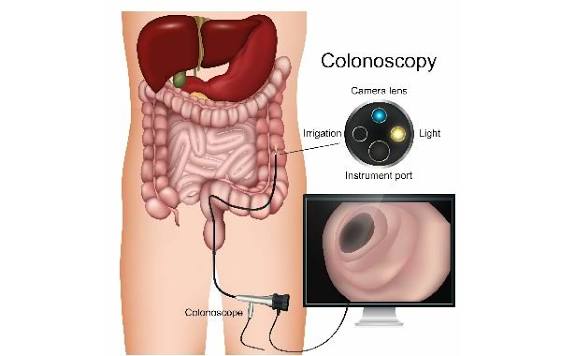 colonoscopy-what-adults-should-know-body — colonoscopy colon polyp removal polypectomy snare endoscope