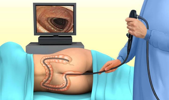 colonoscopy what adults should know — flexible colonoscope colon bowel polyp detection colorectal cancer screening