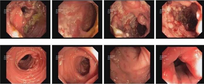 Crohn's disease treatment options including biologics, immunosuppressants and surgical procedures