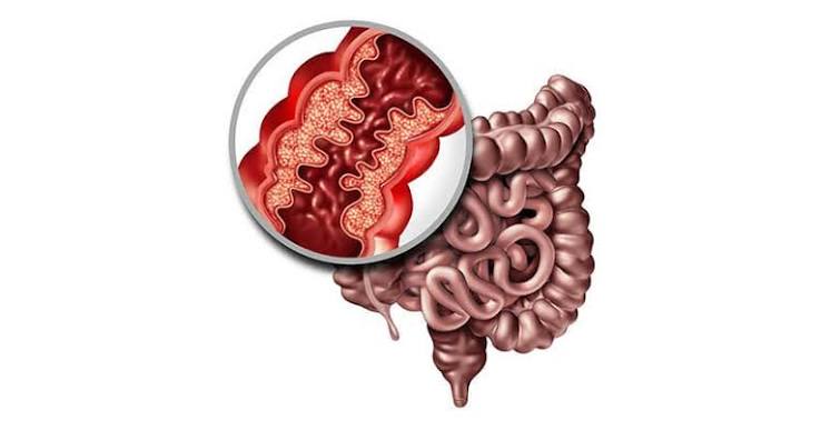 Crohn's disease diagram showing transmural inflammation and skip lesions in the gastrointestinal tract