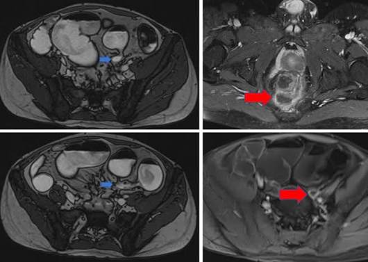 ct-scan-for-digestive-and-liver-problems-body — CT colonography virtual colonoscopy colorectal cancer screening bowel