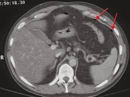 CT scan for digestive and liver problems — computed tomography liver pancreas colon contrast phases abdominal CT