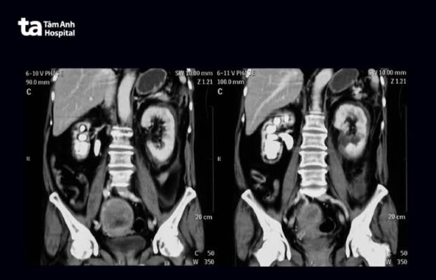 CT scan for kidney problems showing renal stones masses hydronephrosis and CT urogram imaging