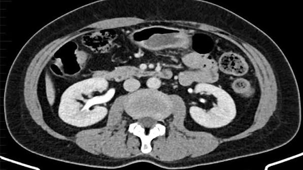 CT urogram and renal mass CT scan phases showing pre-contrast arterial and excretory phase kidney imaging
