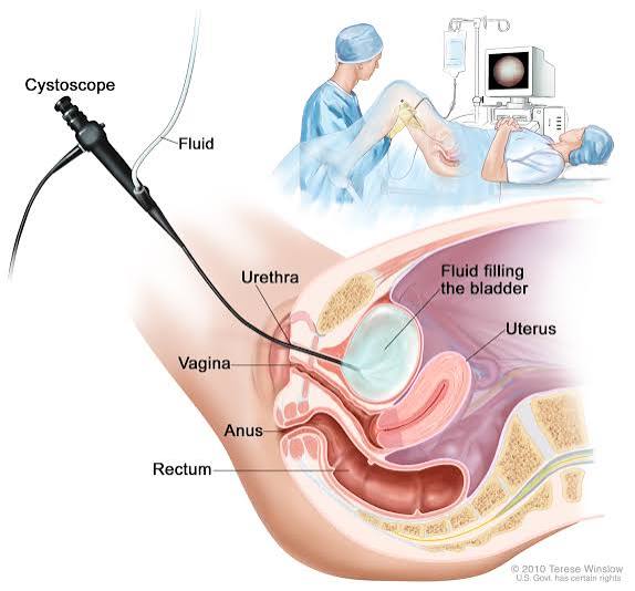 Cystoscopy procedure showing flexible scope bladder examination for hematuria and bladder cancer detection