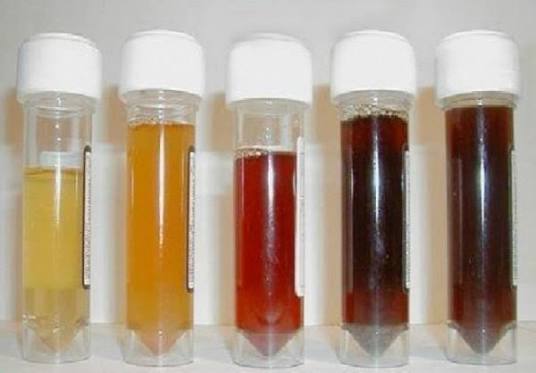 dark-urine-and-liver-health-body — urine dipstick bilirubin test and liver function workup for bilirubinuria