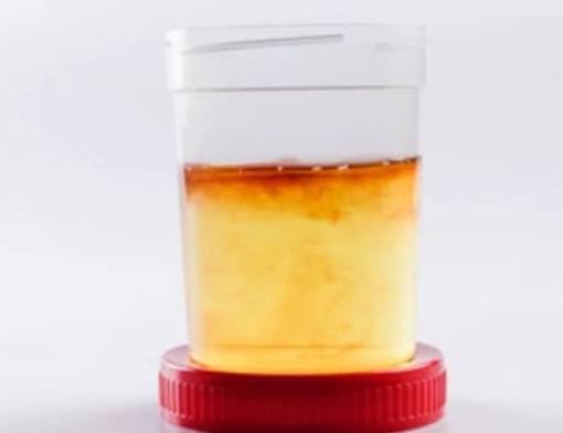 dark urine and liver health — bilirubinuria from conjugated bilirubin in hepatocellular disease and biliary obstruction