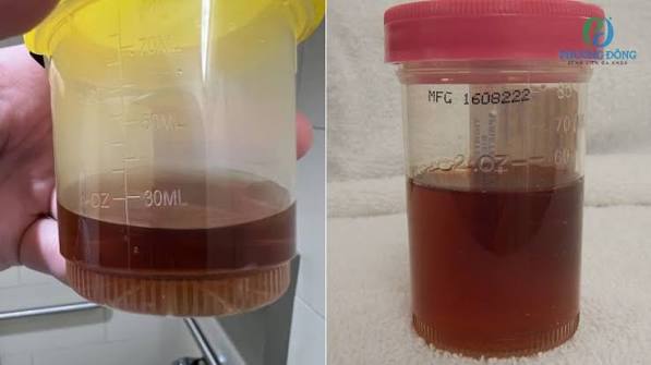 dark urine causes and warning signs liver rhabdomyolysis guide