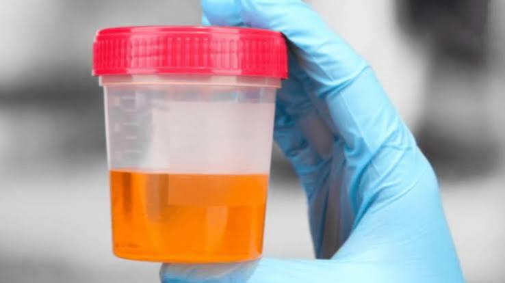 dark urine dehydration bilirubinuria myoglobinuria hemoglobinuria
