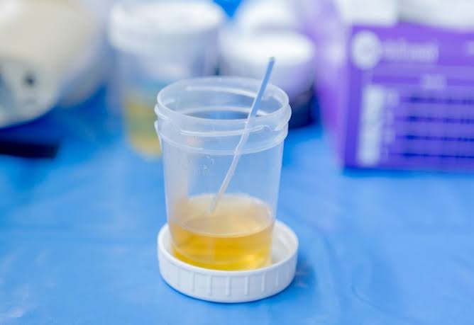 decreased urine output kidney AKI BPH obstruction residual kidney function dialysis