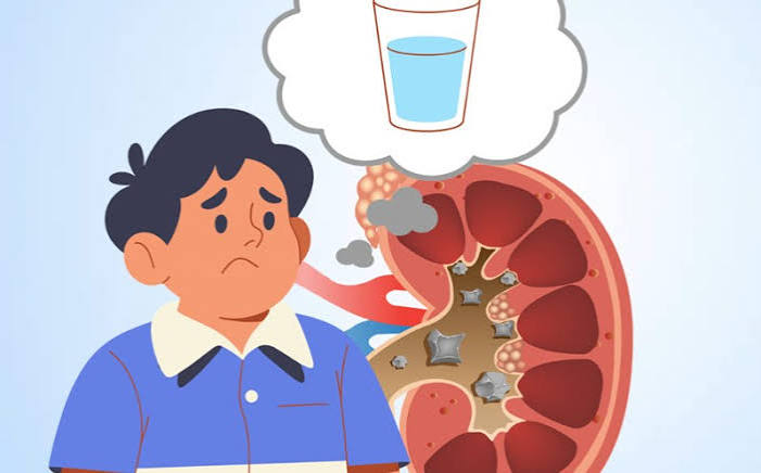 dehydration kidney problems CKD acute kidney injury AKI renal perfusion fluid loss