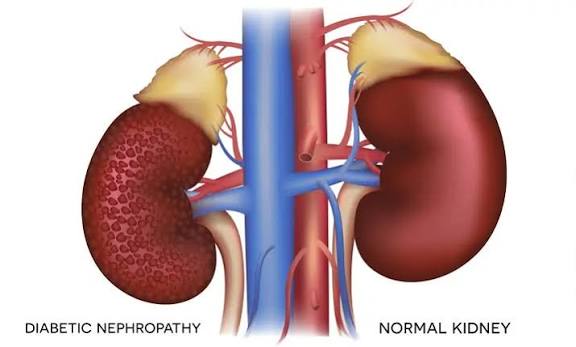 Diagram showing how diabetes damages kidneys through hyperglycemia glomerular hyperfiltration and RAAS activation leading to diabetic nephropathy