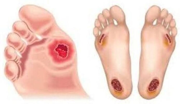 diabetes and infections — illustration showing the multiple body sites affected by diabetes-related immune dysfunction including skin lungs urinary tract and feet