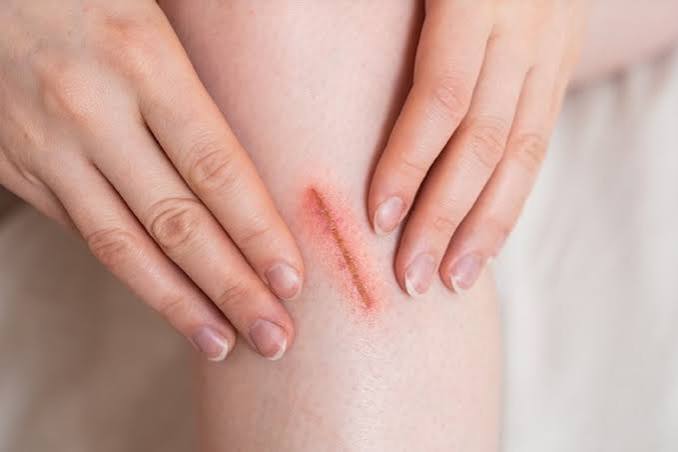 diabetes wound healing impairment — close-up of a chronic non-healing wound on an adult foot with surrounding healthy skin showing the contrast between normal tissue and the stalled healing wound