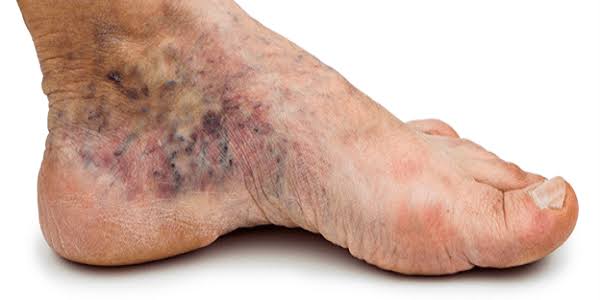 diabetic foot ulcer stages — diagram showing the Wagner classification from superficial skin ulcer through deep wound with bone involvement to gangrene requiring amputation