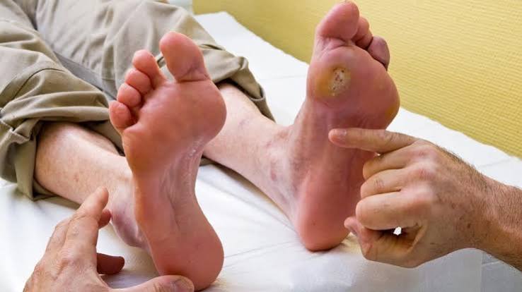 diabetic foot problems prevention — illustration of a foot showing the key inspection points including plantar surface toes heels and nail beds with annotations for daily self-examination