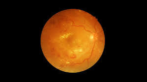 proliferative diabetic retinopathy — retinal photograph showing new blood vessel growth (neovascularization) extending from the optic disc and major arcades in advanced diabetic eye disease