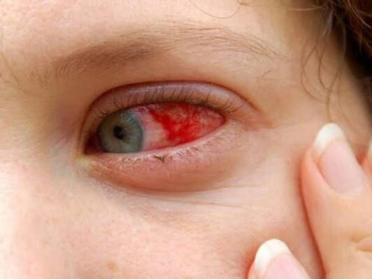 diabetic retinopathy — fundus photograph showing retinal microaneurysms hemorrhages and cotton wool spots in a patient with non-proliferative diabetic retinopathy