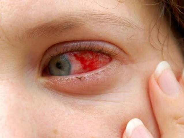 diabetic retinopathy — fundus photograph showing retinal microaneurysms hemorrhages and cotton wool spots in a patient with non-proliferative diabetic retinopathy