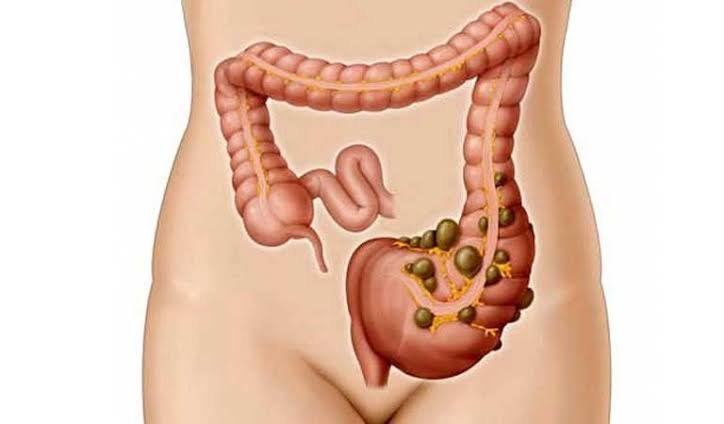 High-fibre foods including vegetables, legumes, whole grains and fruit that help prevent diverticulosis and reduce diverticulitis risk