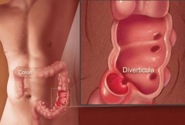 Illustration of the colon showing diverticula pouches along the sigmoid segment, explaining diverticulosis and diverticulitis