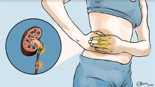 early signs of kidney stones — person experiencing dull flank discomfort and blood in urine as warning signs before severe kidney stone pain begins