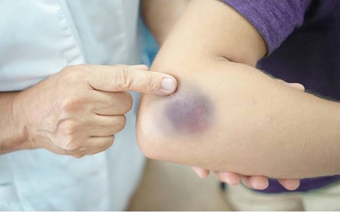 easy-bruising-and-liver-function-body — PT INR and platelet count testing for liver-related coagulopathy