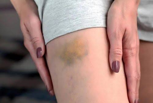 easy bruising and liver function — coagulopathy from clotting factor deficiency in cirrhosis and liver disease