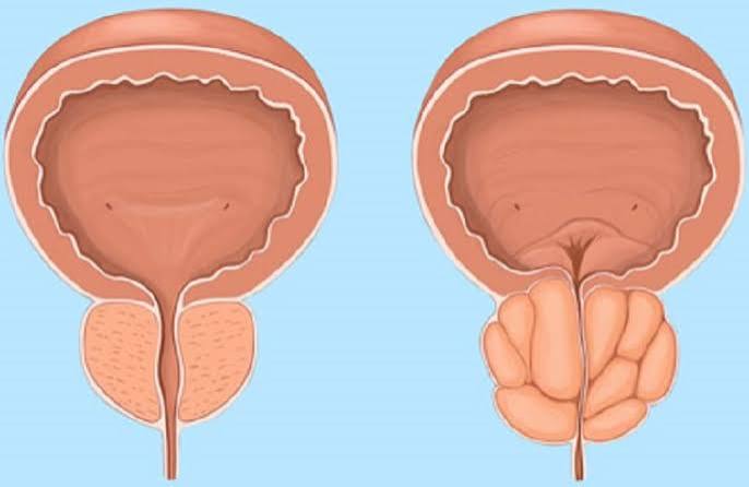 enlarged prostate and urination problems — comparison diagram showing normal prostate urethral opening versus BPH-compressed urethra causing weak stream and incomplete emptying