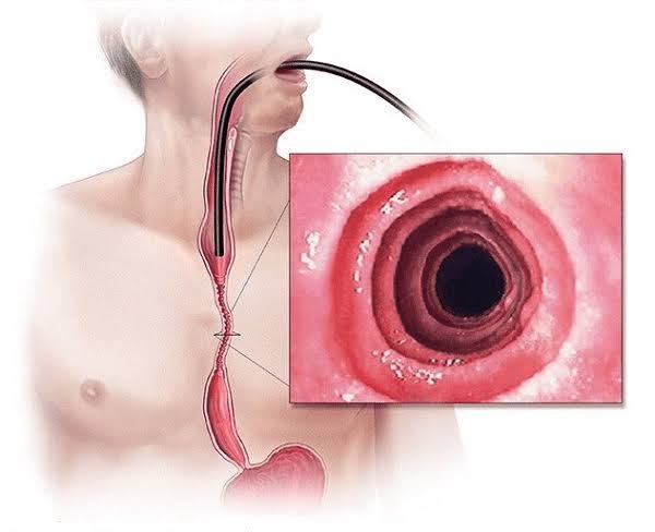 eosinophilic esophagitis endoscopy rings furrows diagnosis biopsy treatment