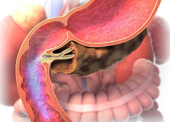 exocrine pancreatic insufficiency EPI fat malabsorption steatorrhoea weight loss fecal elastase chronic pancreatitis cystic fibrosis