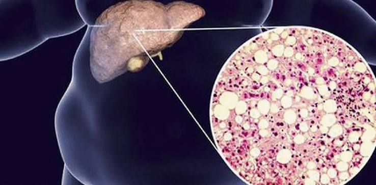 fatty-liver-and-diabetes-body — MASLD diabetes GLP-1 pioglitazone SGLT2 liver fibrosis glycaemic control management