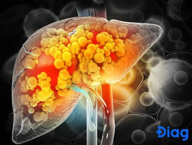 fatty liver and high cholesterol MASLD dyslipidaemia triglycerides HDL LDL liver lipid metabolism statin