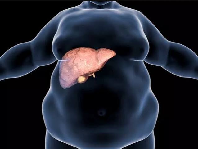 fatty liver and obesity MASLD visceral adiposity insulin resistance weight loss liver health