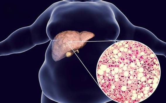 fatty liver causes risk factors MASLD obesity insulin resistance metabolic syndrome type 2 diabetes